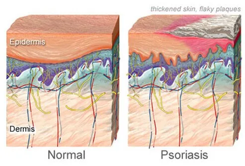 psoriasis-causes-root