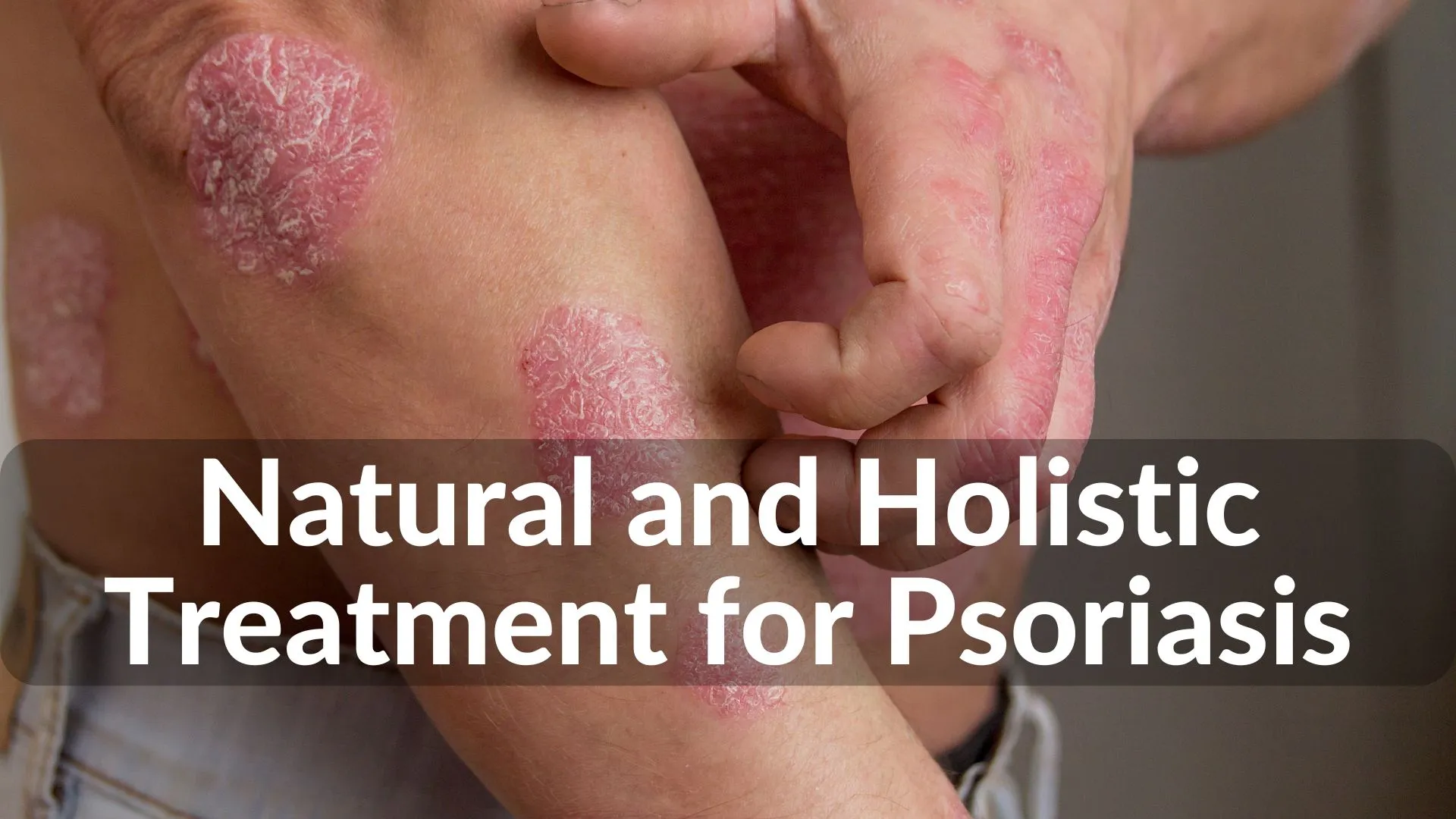 The Best Natural Treatments and Holistic Healing for Psoriasis