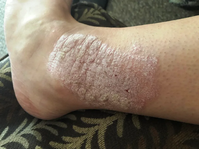 Plaque Psoriasis