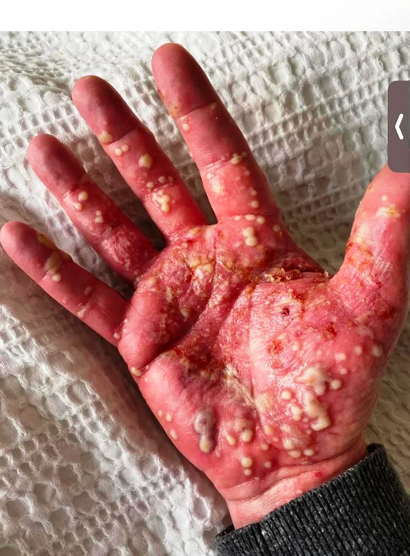 Pustular Psoriasis