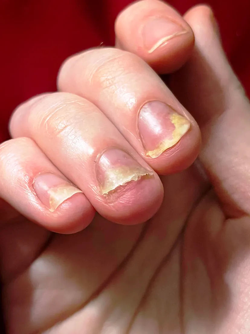 Nail Psoriasis