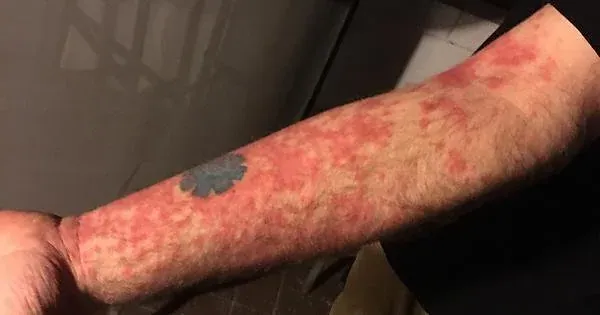 Guttate Psoriasis