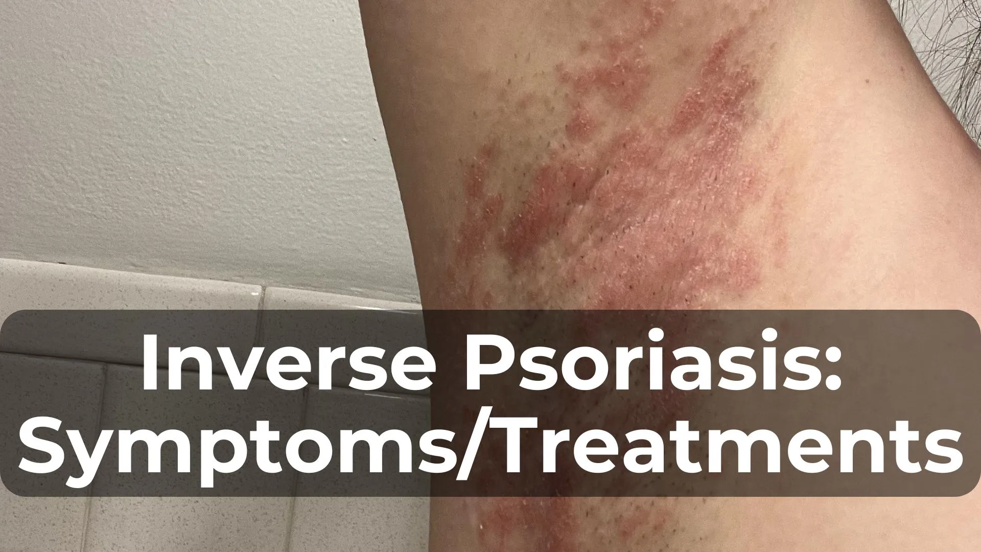 Understanding Inverse Psoriasis: Symptoms and Treatments