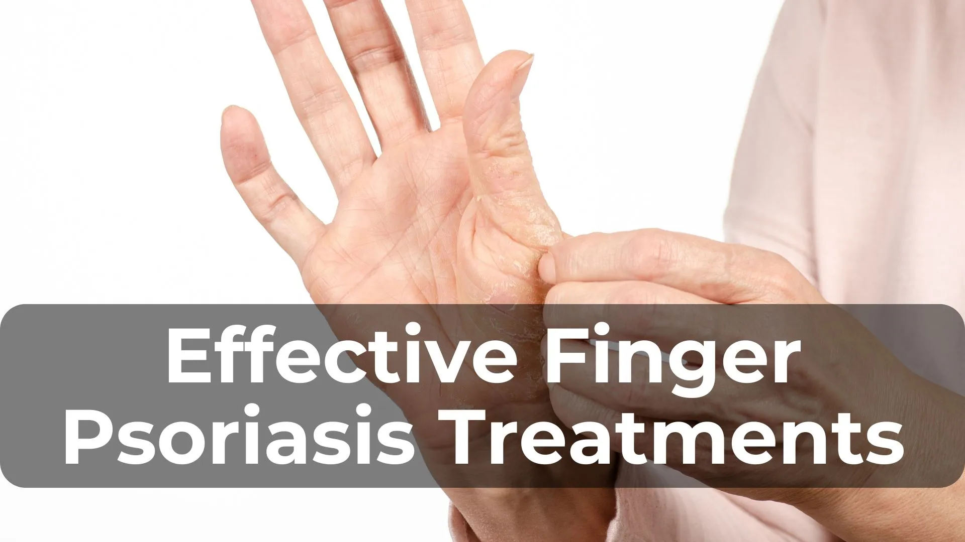 Effective Finger Psoriasis Treatments: What Works Best