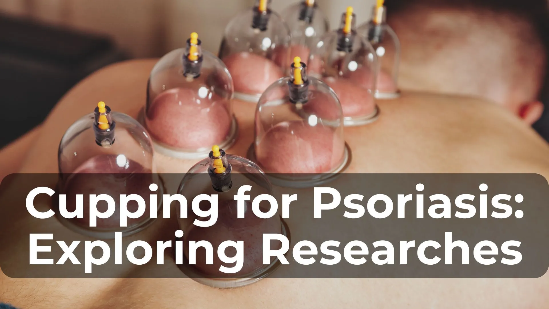 Cupping for Psoriasis: Exploring the Latest Research