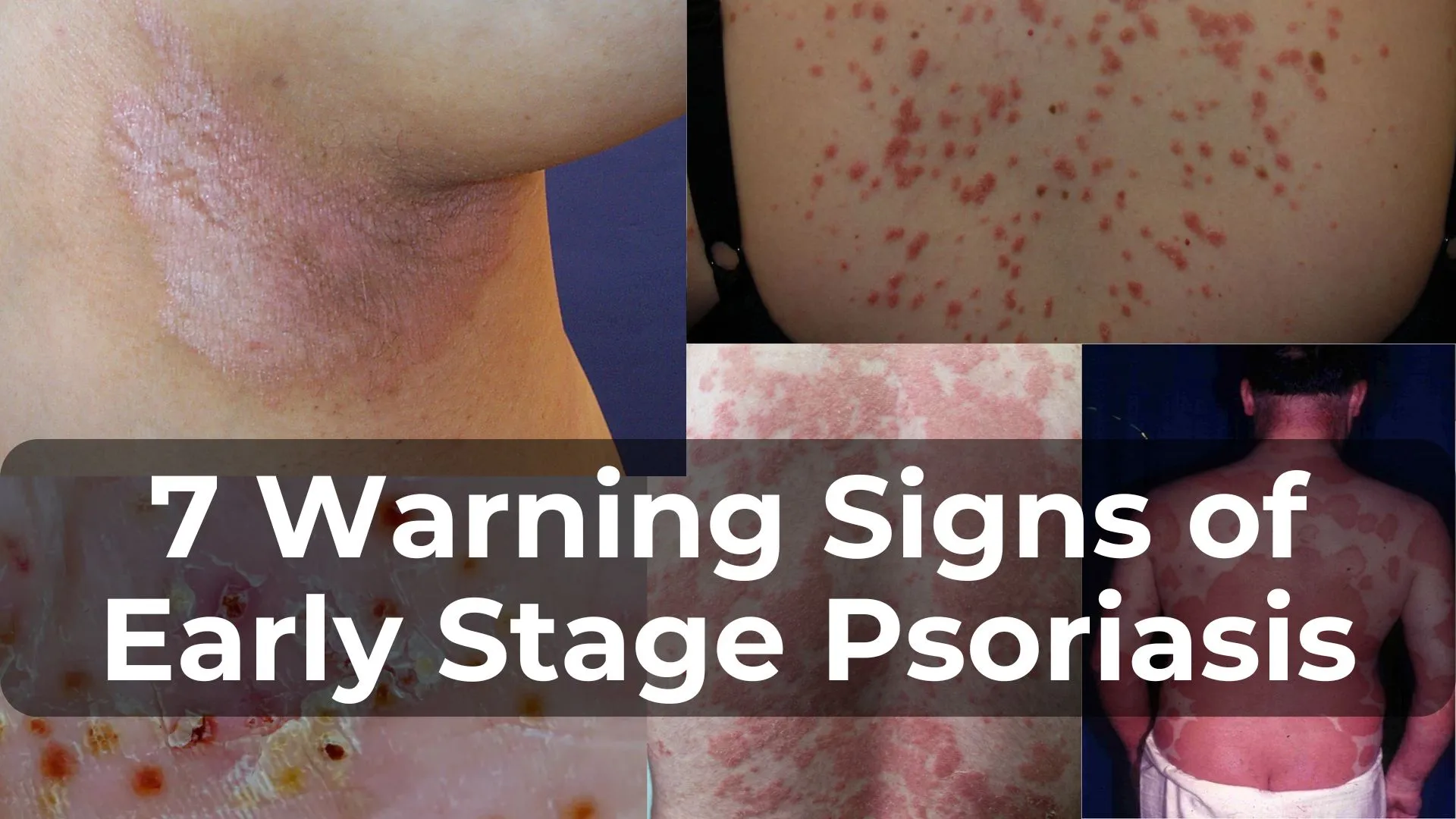 7 Warning Signs of Early Stage Psoriasis