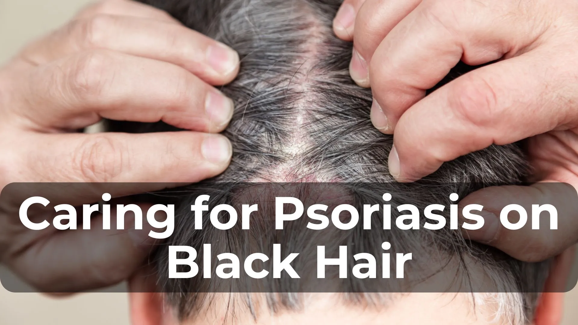 Caring for Psoriasis on Black Hair: Tips and Products