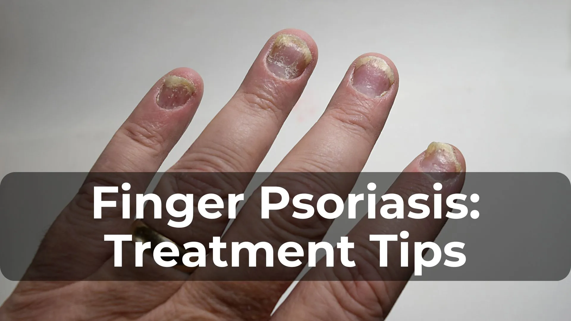 Finger Psoriasis: Treatment Tips and Tricks