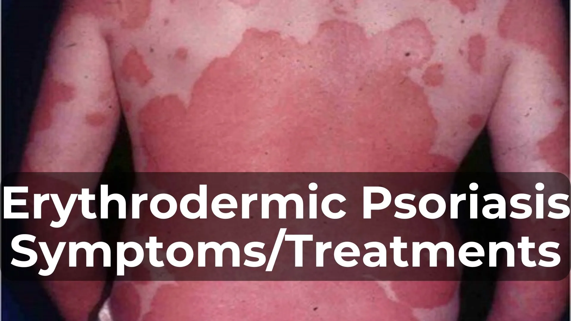 Understanding Erythrodermic Psoriasis: Symptoms and Treatments