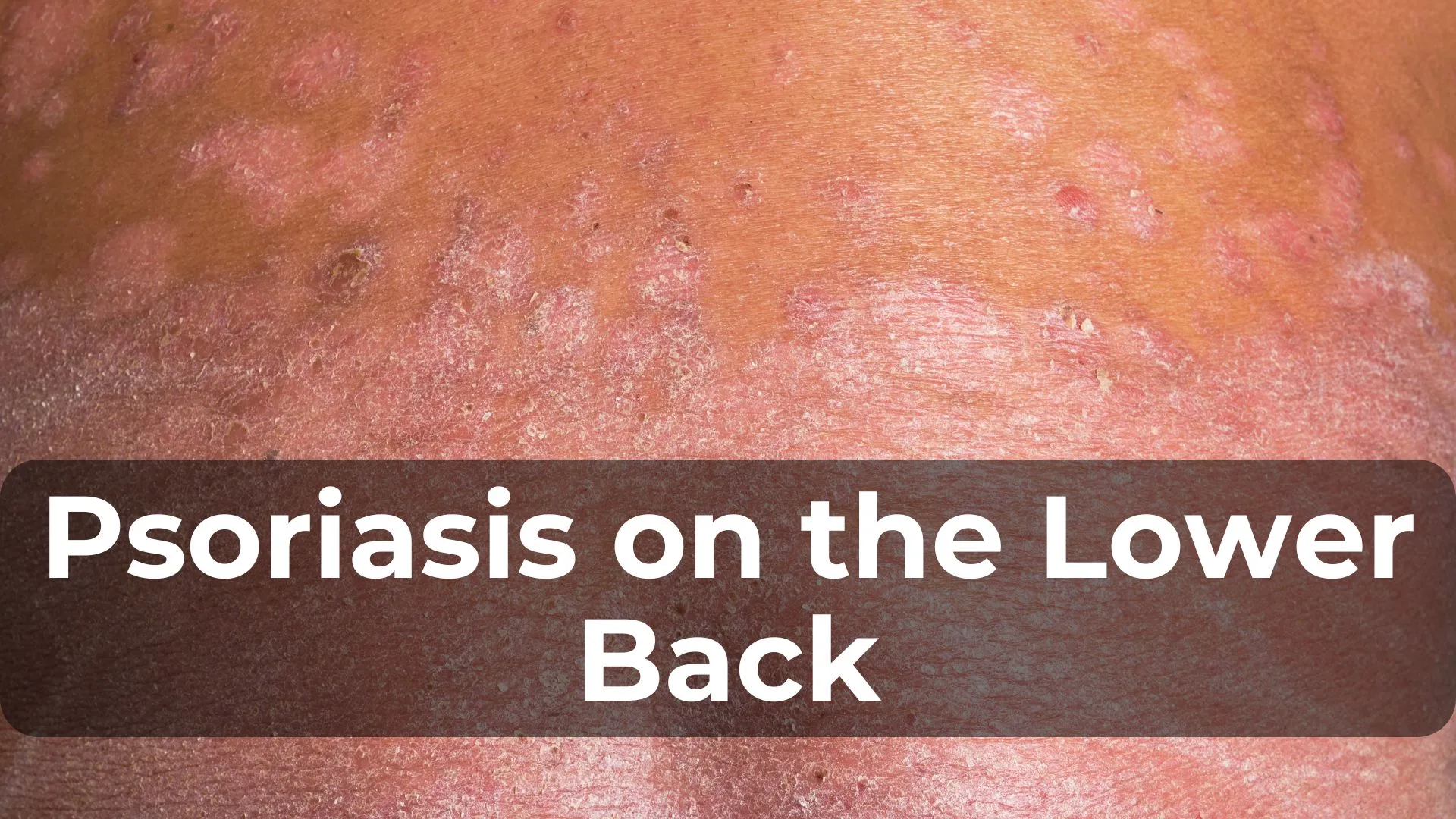 Psoriasis on the Lower Back: Managing Pain and Symptoms