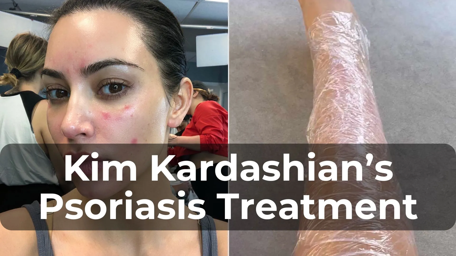 Kim Kardashian's Psoriasis Treatment: What You Can Learn