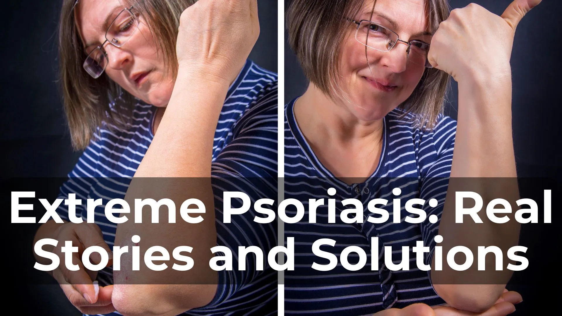 Dealing with Extreme Psoriasis: Real Stories and Solutions