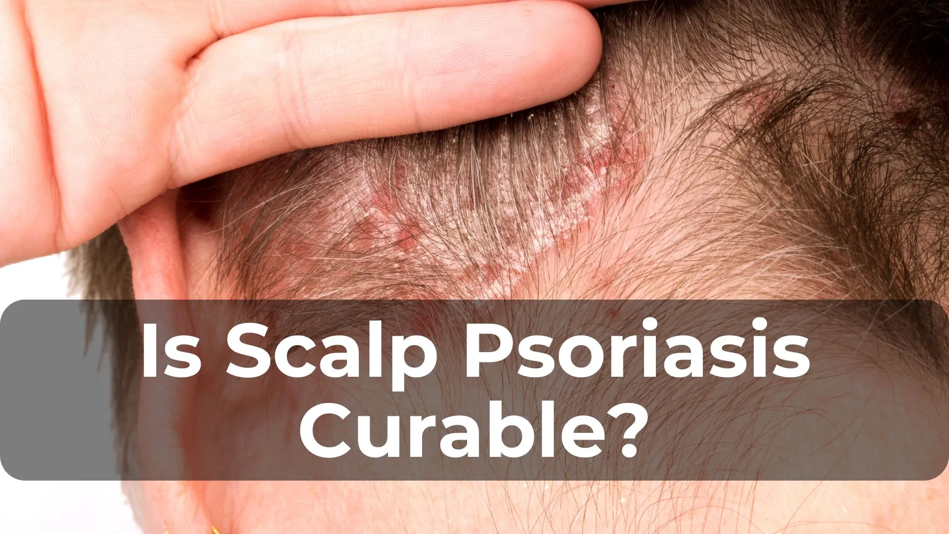 Is Scalp Psoriasis Curable? Exploring Treatment Options