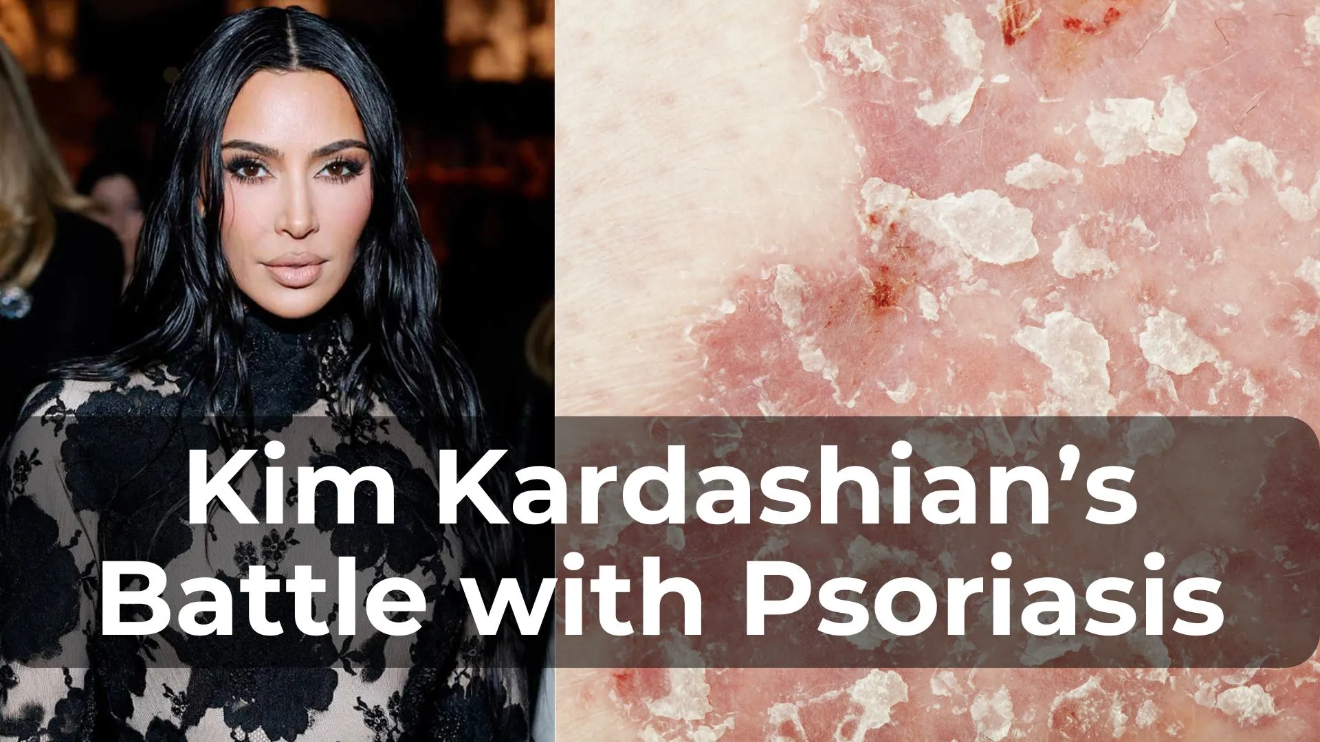 Kim Kardashian's Battle with Psoriasis: What We Know