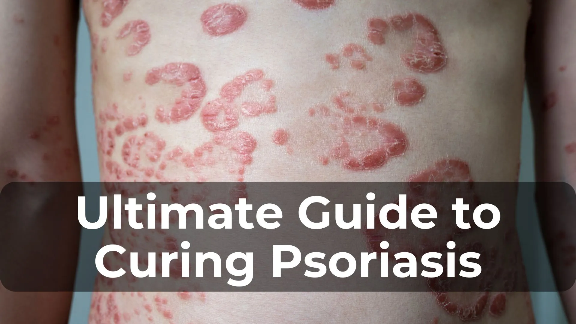 The Ultimate Guide to Curing Psoriasis Skin Disease