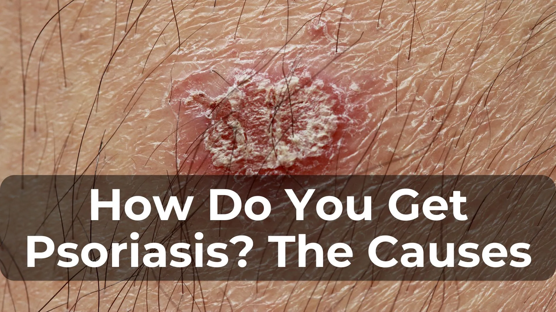 How Do You Get Psoriasis? Exploring the Causes