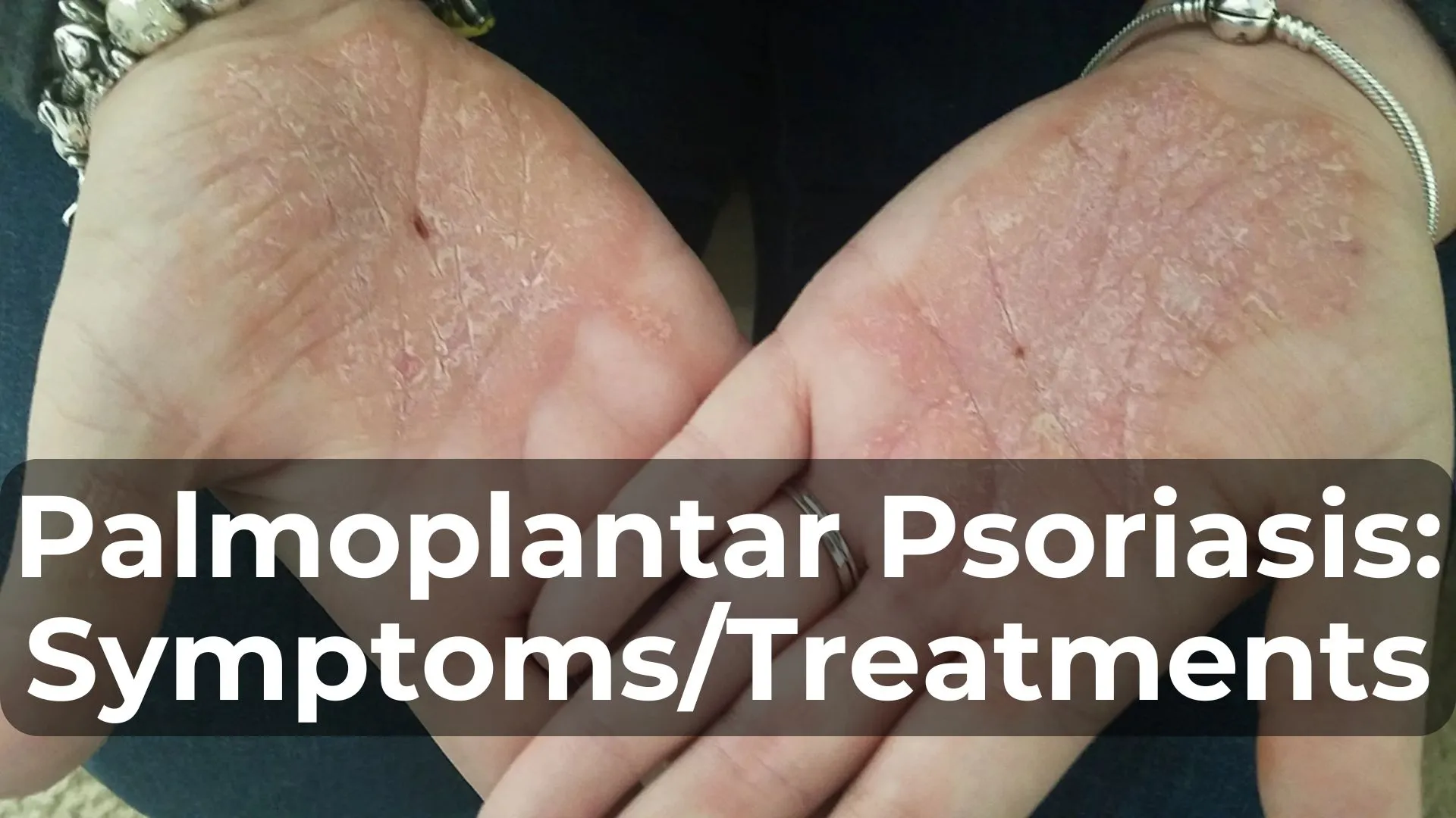 Palmoplantar Psoriasis: Symptoms and Treatments