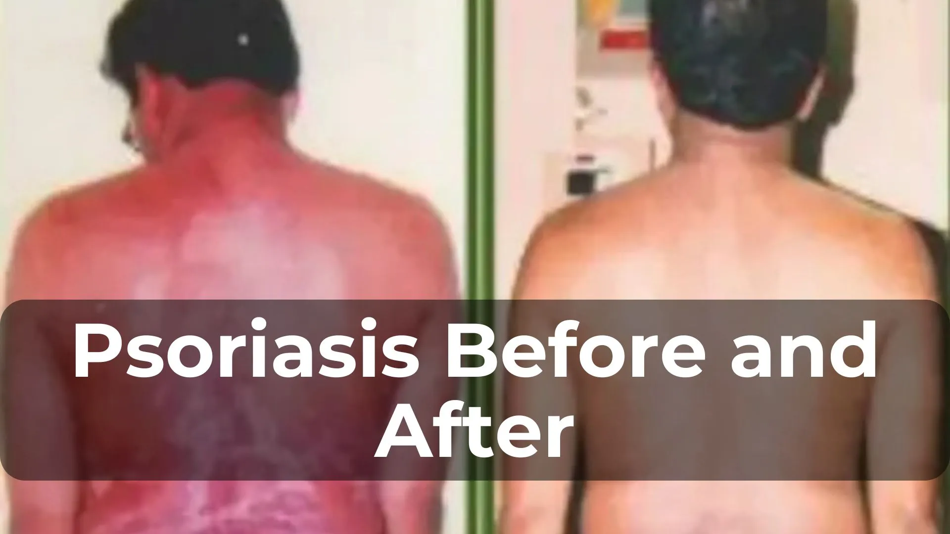 Psoriasis Before and After: Inspiring Transformation Stories