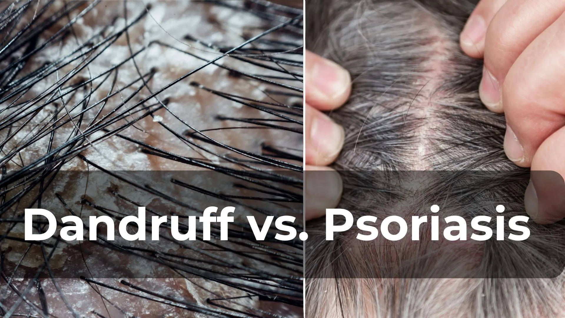 Dandruff vs. Psoriasis: How to Tell the Difference