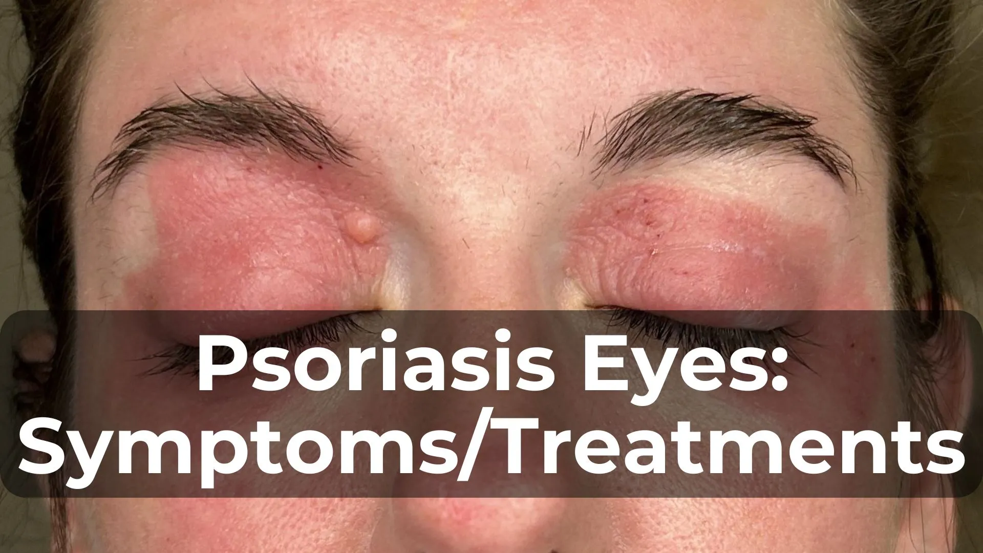 Psoriasis Eyes: Symptoms, Treatments, and Care Tips