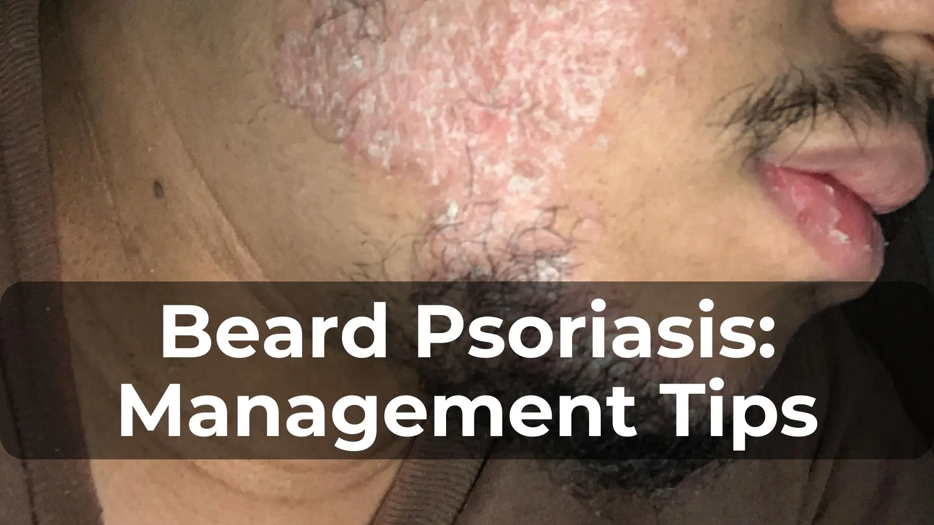 Beard Psoriasis: Tips and Tricks for Management