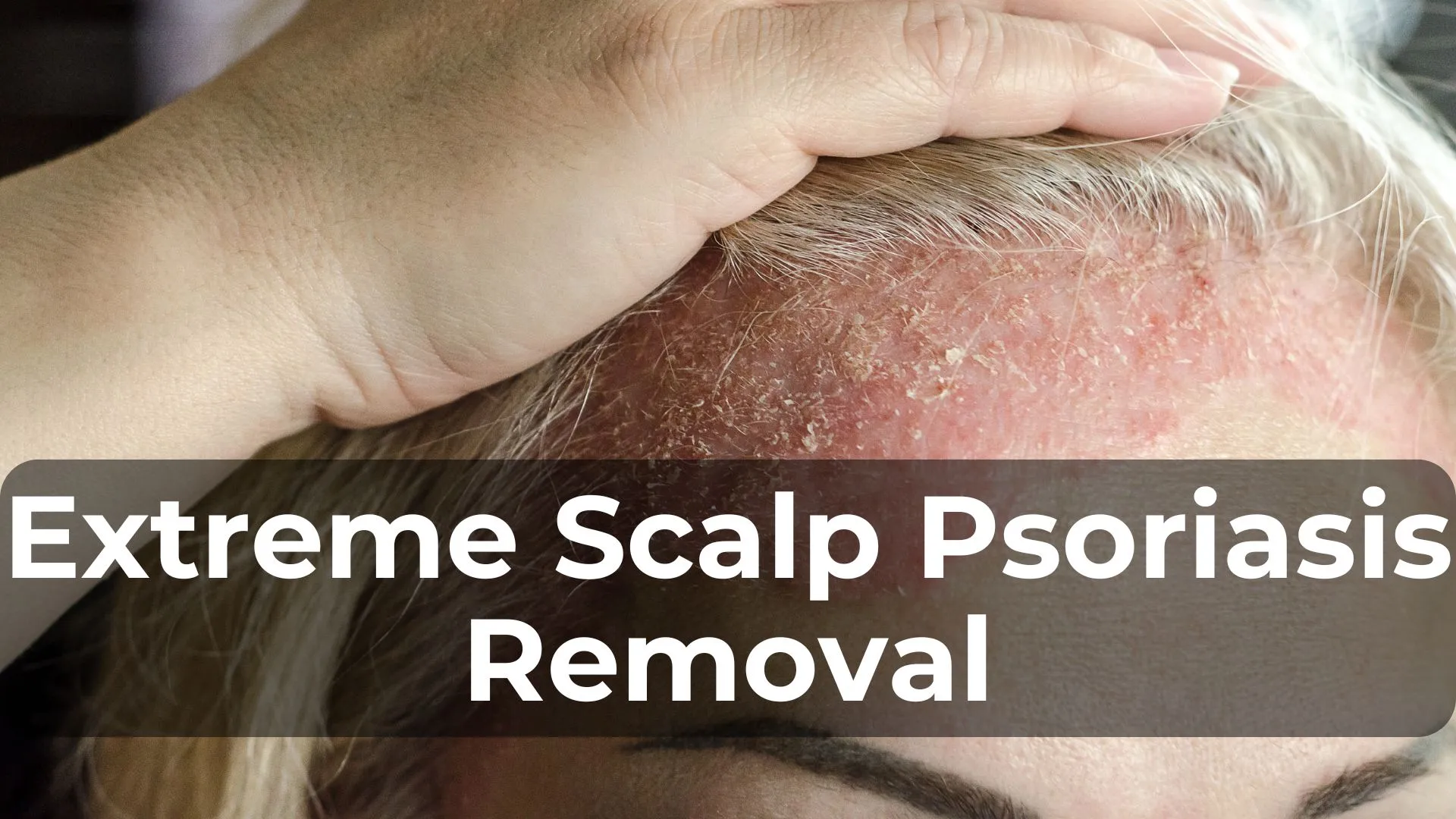 Extreme Scalp Psoriasis Removal: What You Need to Know