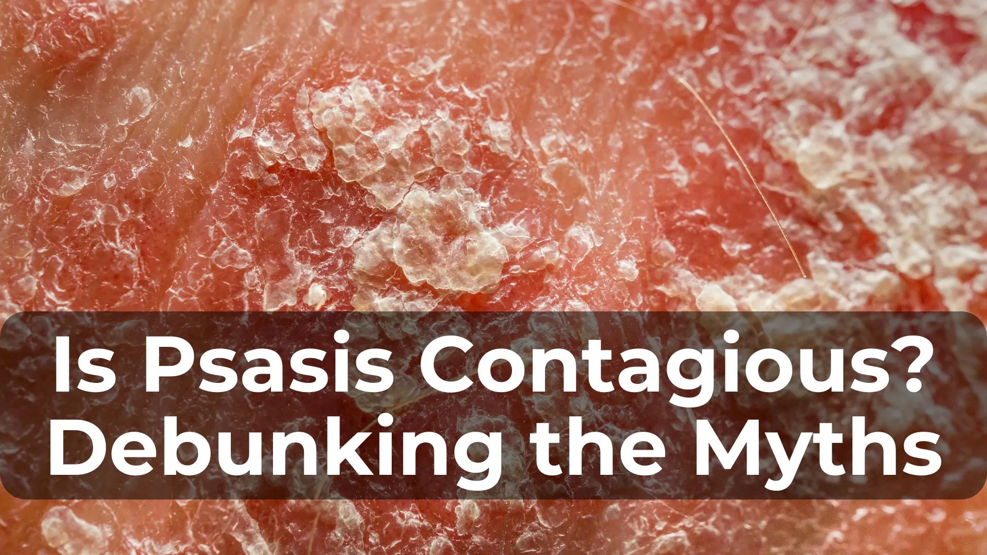 Is Psasis Contagious? Debunking the Myths