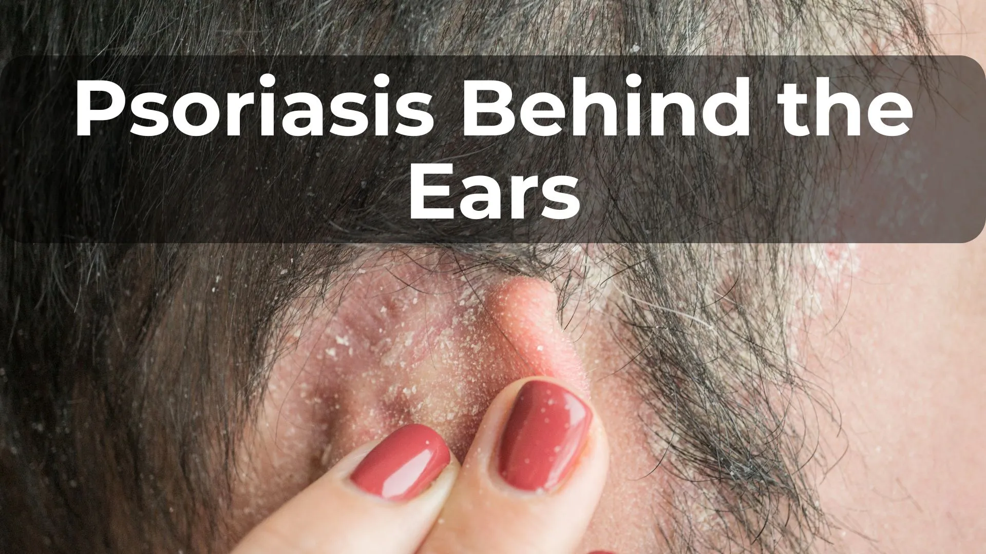 Psoriasis Behind the Ears: Causes and Treatments