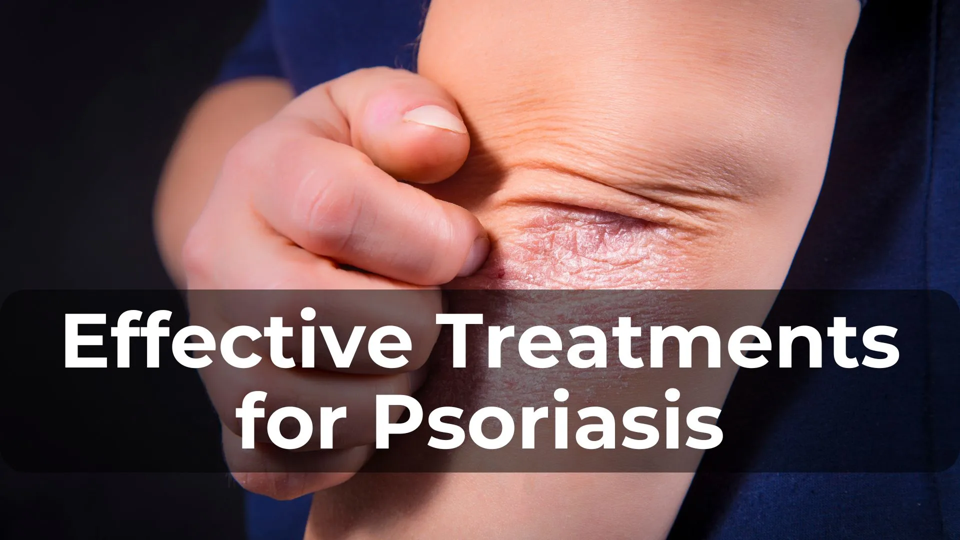 Effective Treatments for Psoriasis: A Comprehensive Guide