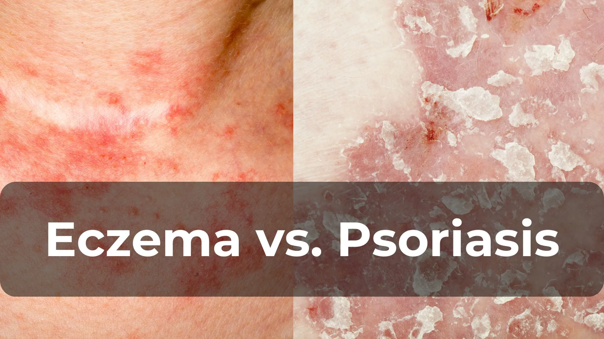 Eczema vs. Psoriasis: Understanding the Differences