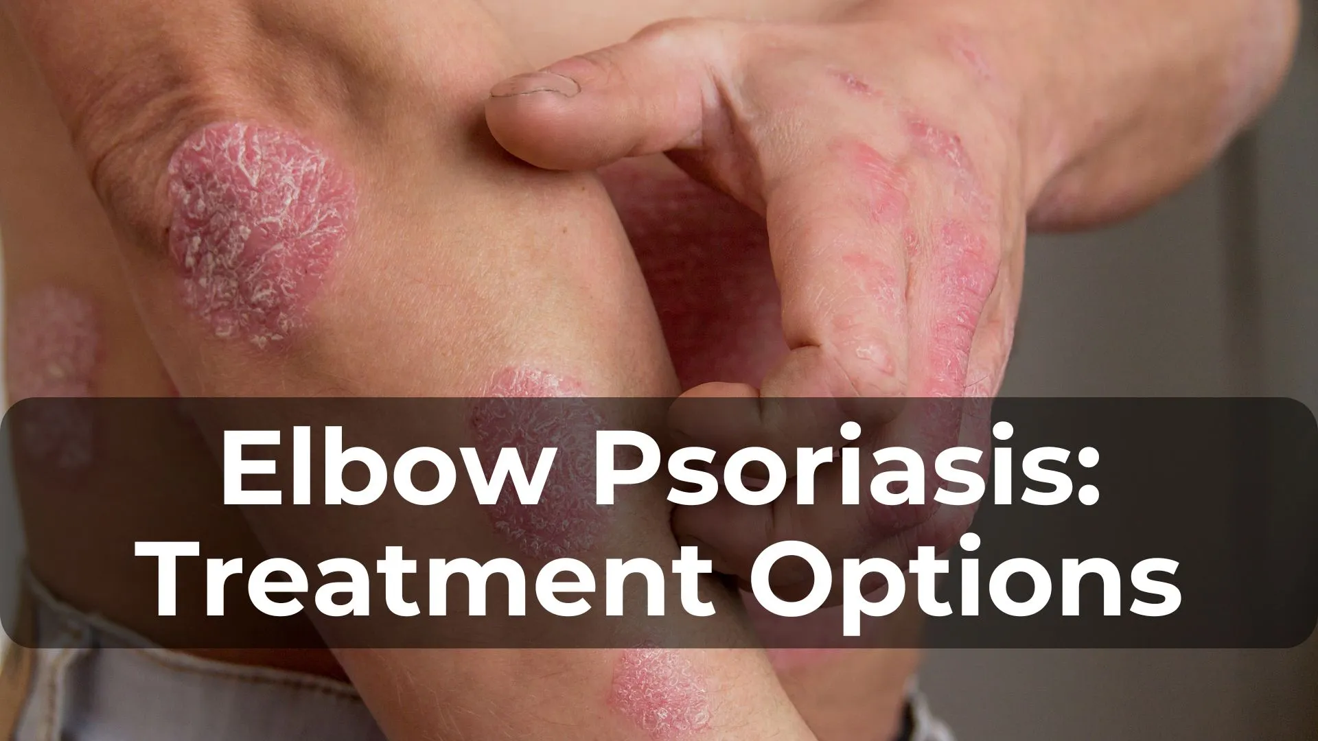 Elbow Psoriasis: Causes, Symptoms, and Treatment Options