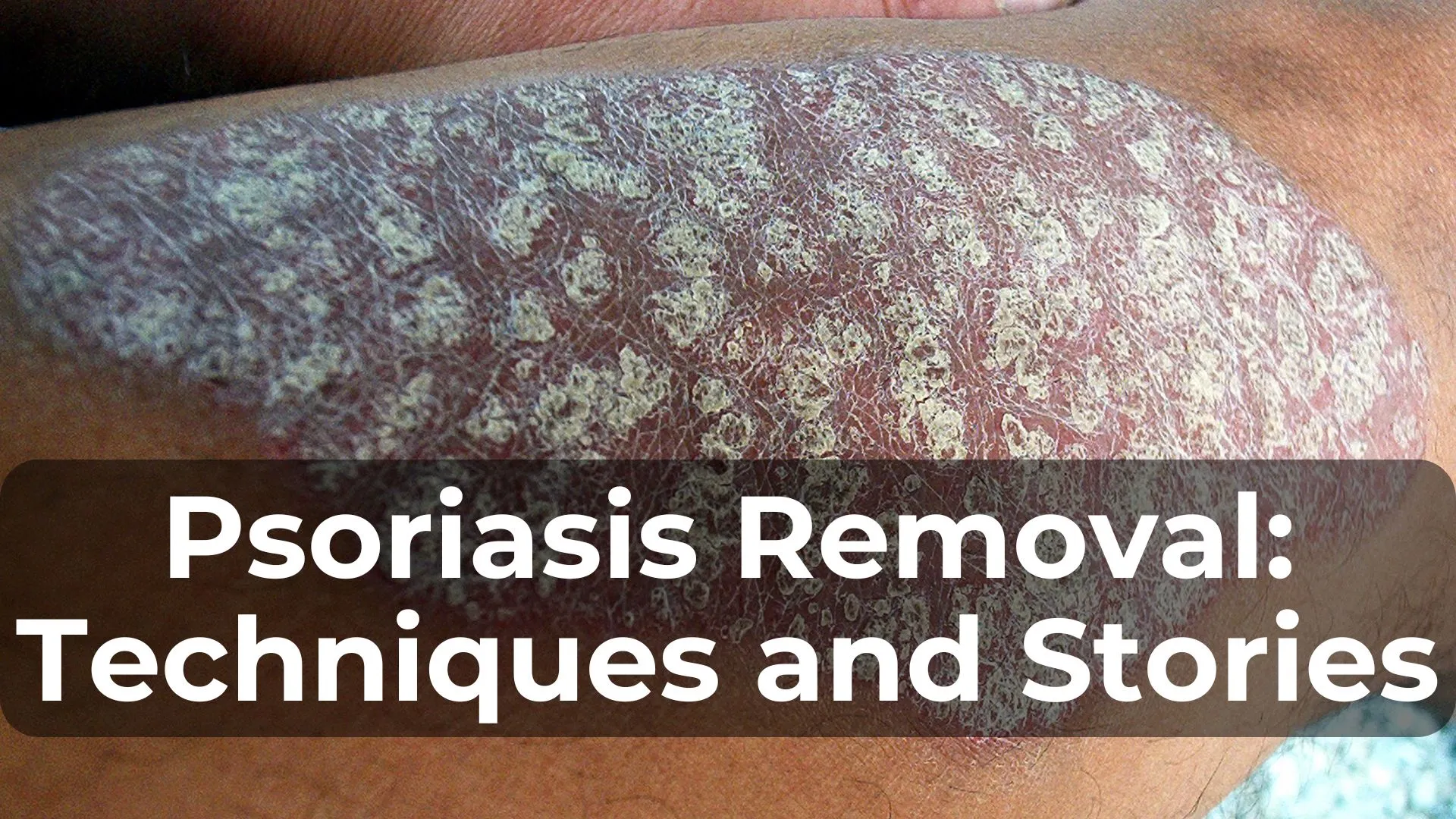 Psoriasis Removal: Techniques and Success Stories