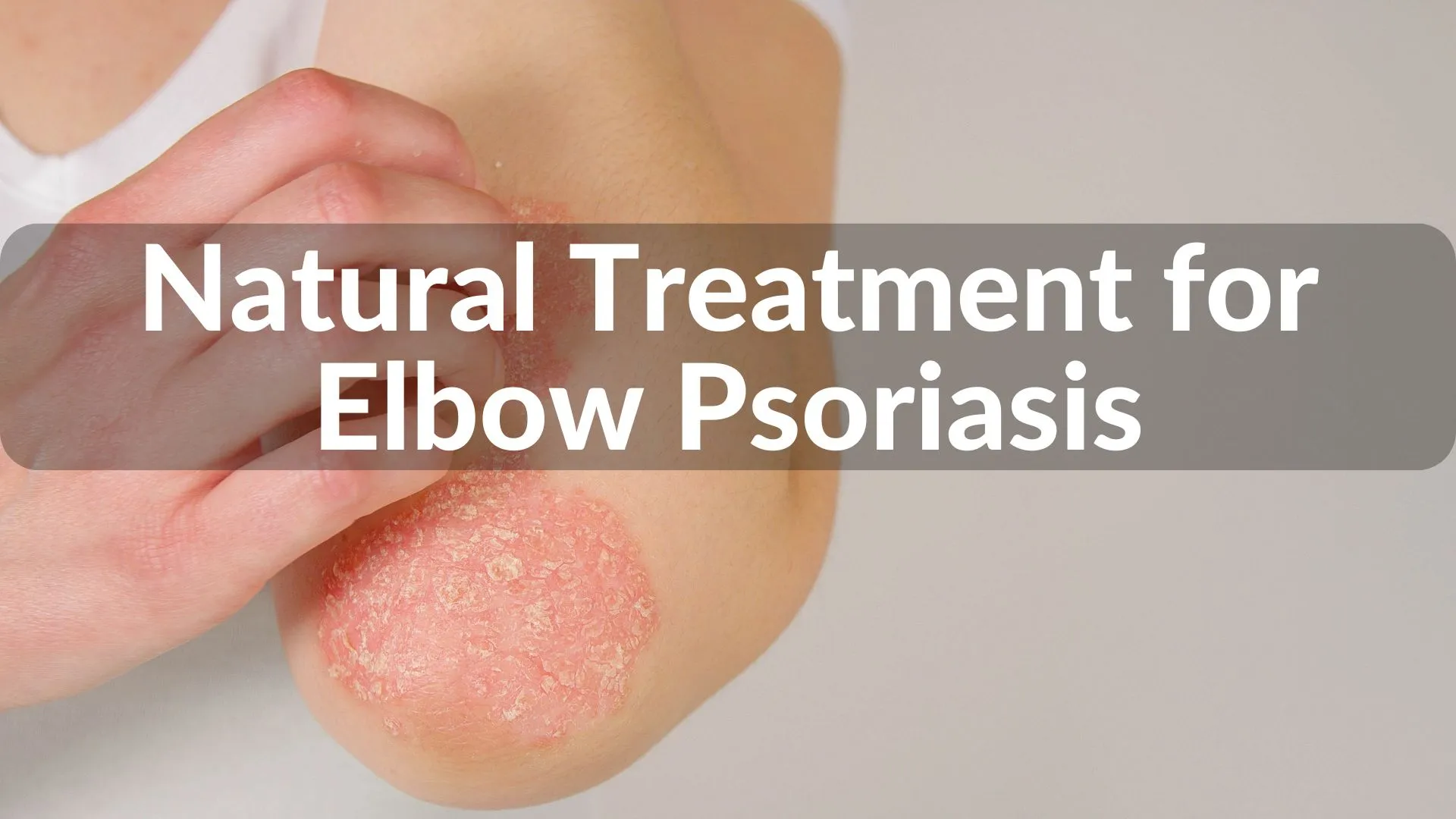 Best Natural Treatments for Elbow Psoriasis Healing