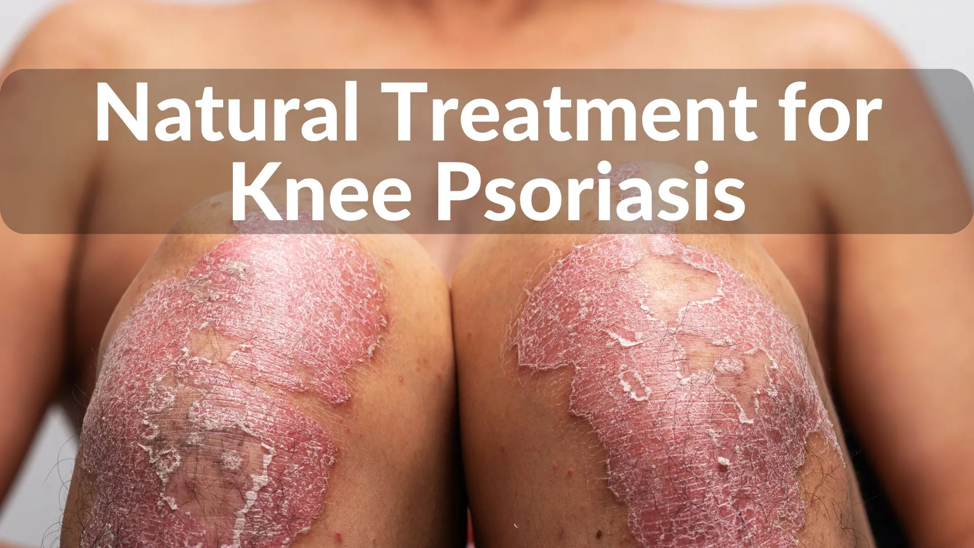 Best Natural Treatments for Knee Psoriasis Healing