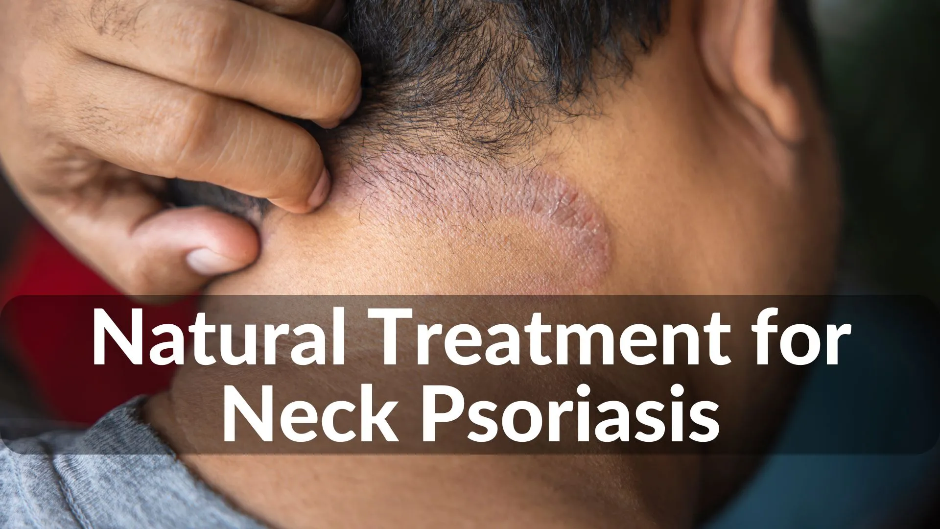 Best Natural Treatments for Neck Psoriasis Healing