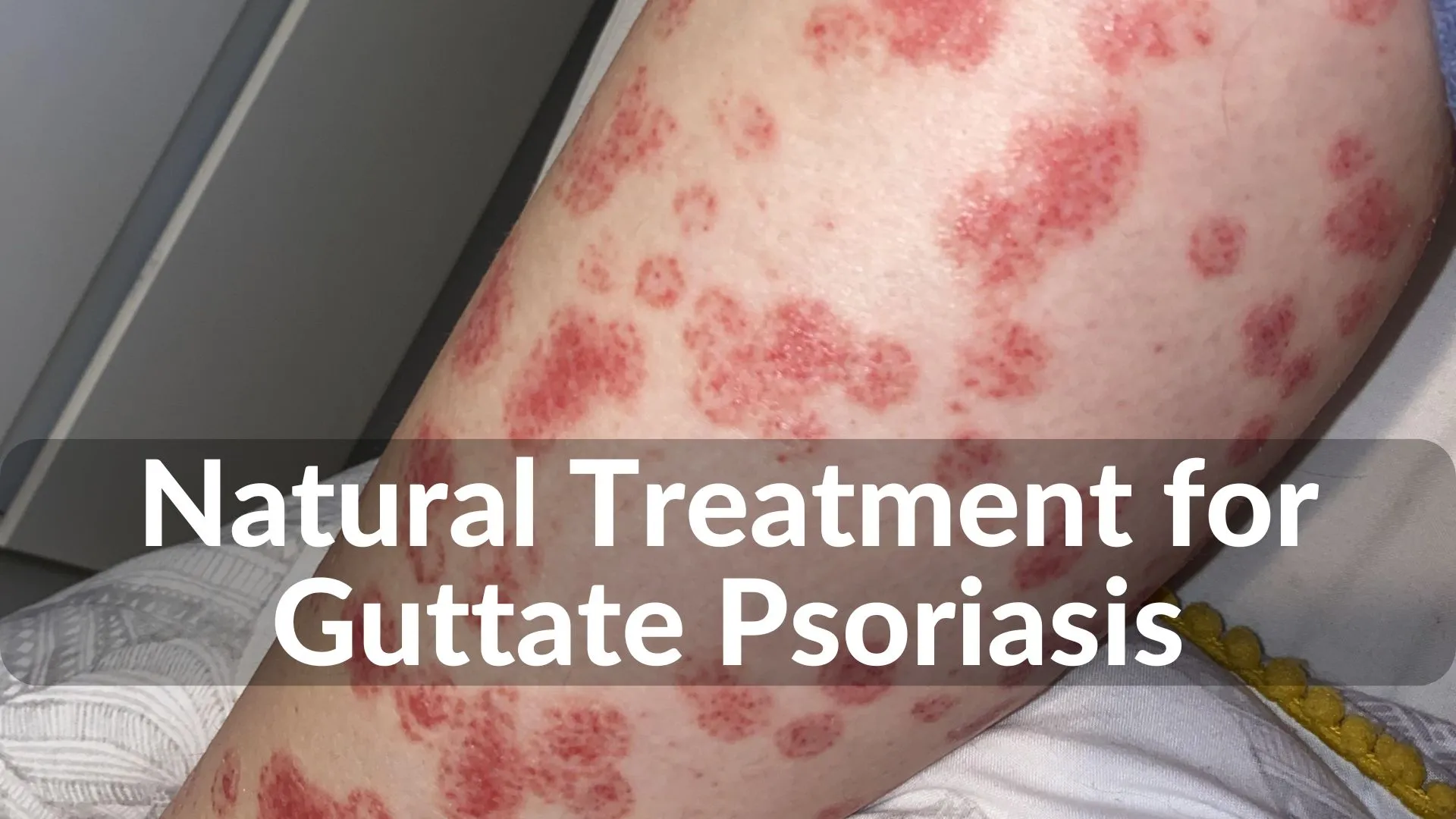 Best Natural Treatments for Guttate Psoriasis: Holistic Healing