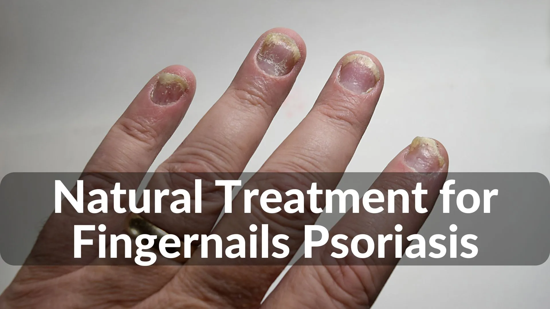 Best Natural Treatments for Fingernails Psoriasis Healing