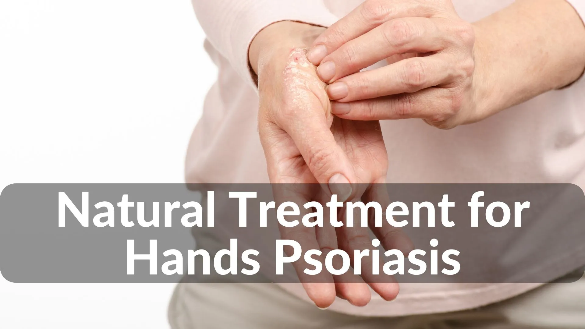 Best Natural Treatments for Hands Psoriasis Healing