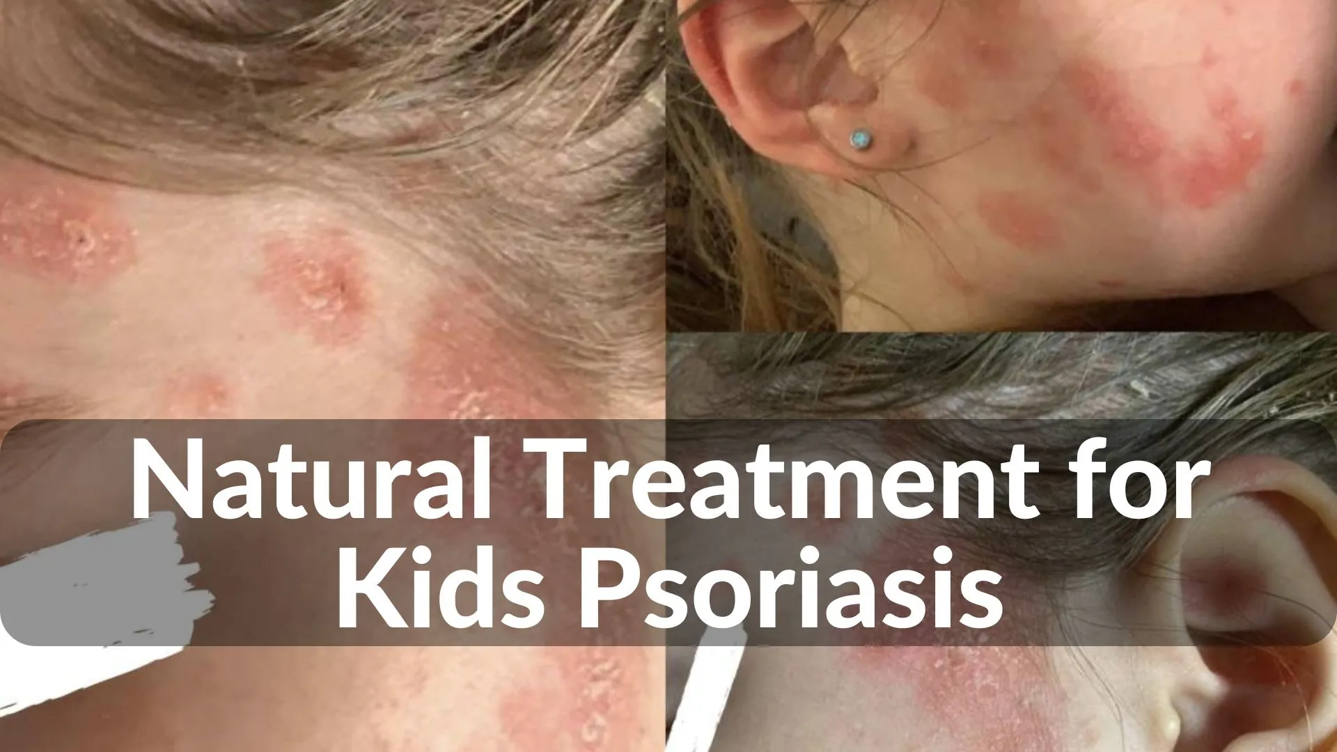 Best Natural Treatments for Kids Psoriasis Healing