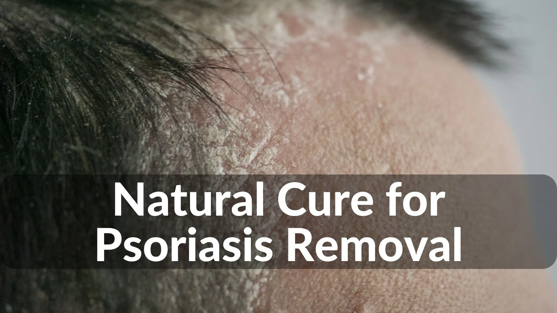 Best Natural Cure for Psoriasis Removal