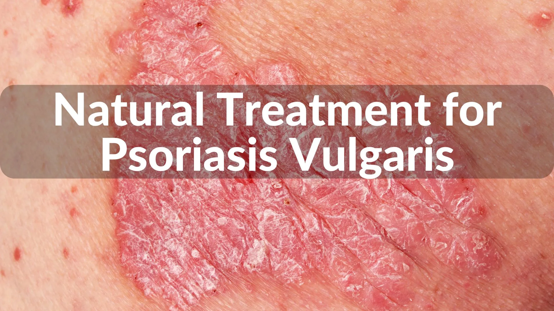 Best Natural Treatments for Vulgaris Psoriasis: Holistic Healing