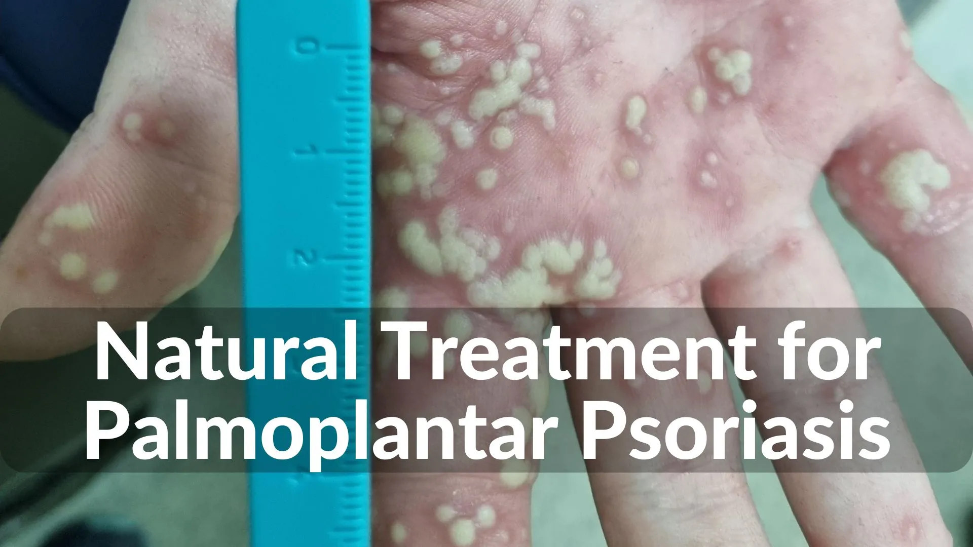 Best Natural Treatments for Palmoplantar Psoriasis Healing