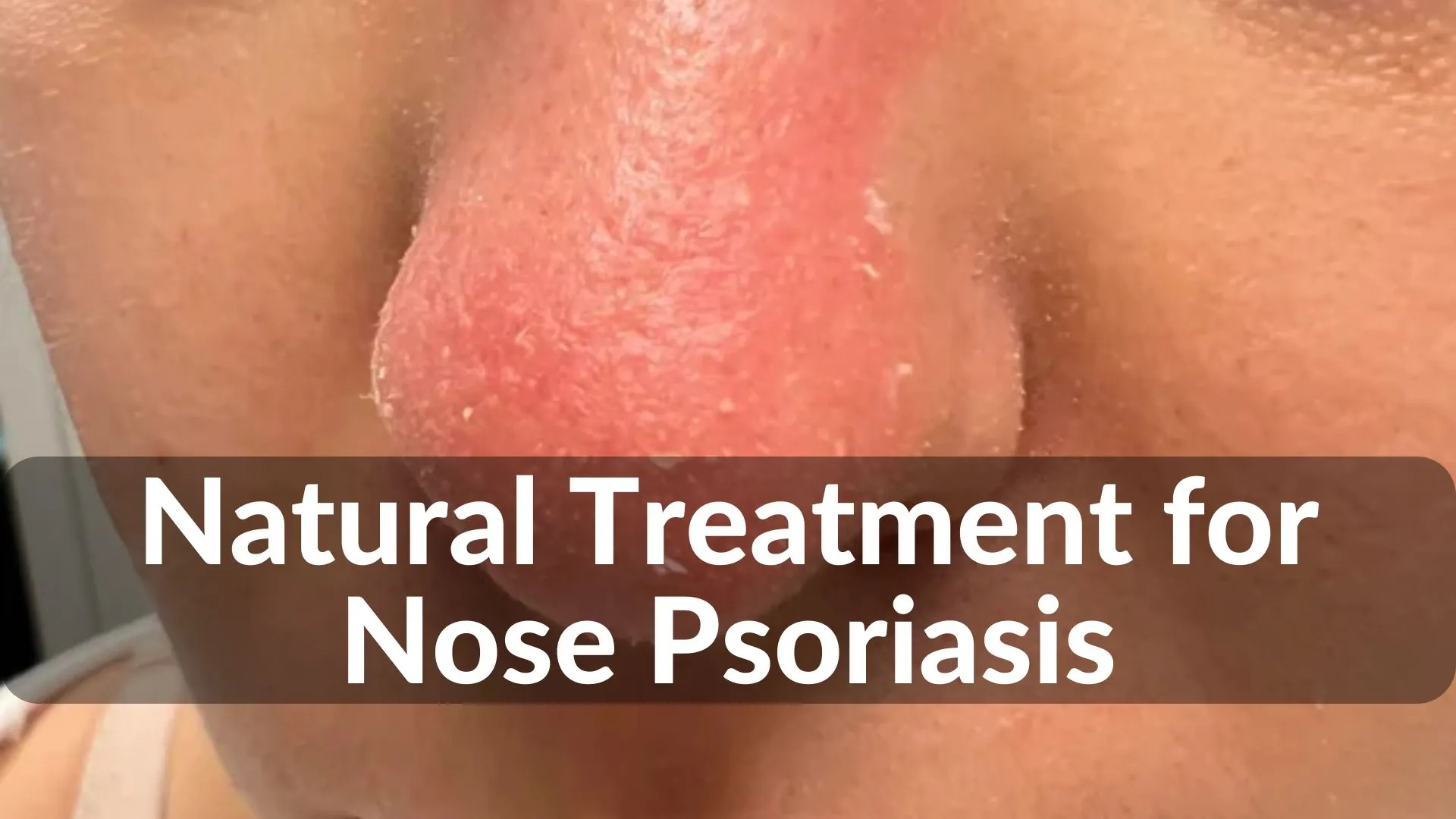 Best Natural Treatments for Nose Psoriasis Healing