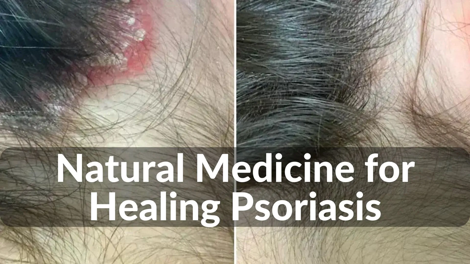 Best Natural Medicine for Healing Psoriasis