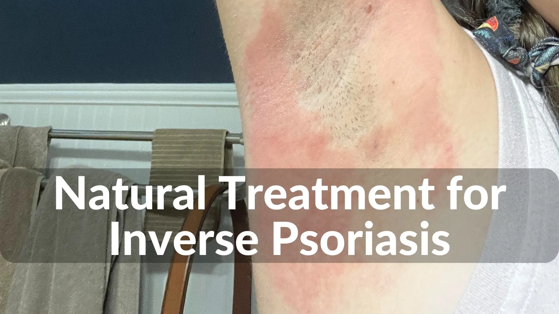 Best Natural Treatments for Inverse Psoriasis: Holistic Healing