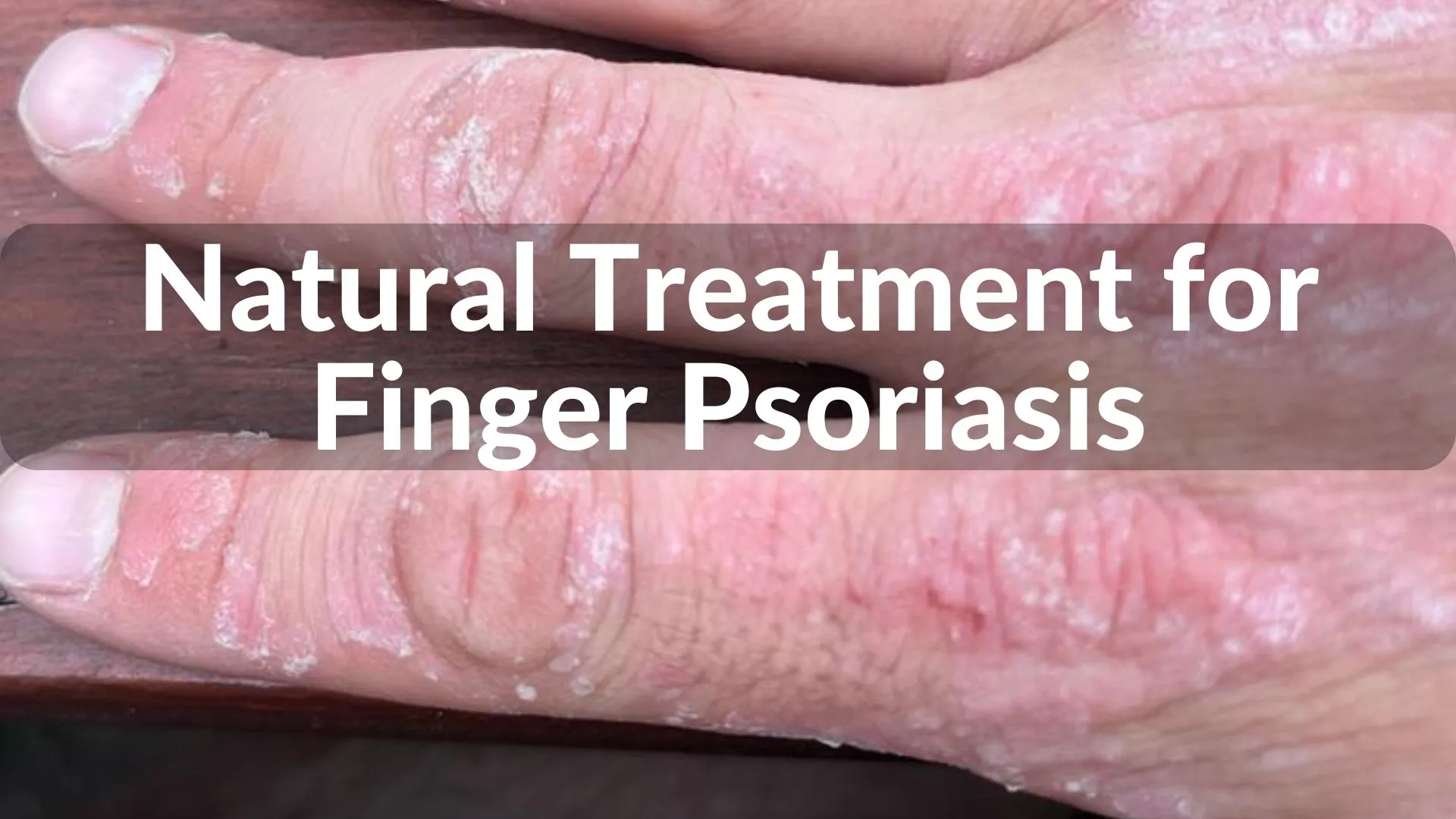 Best Natural Treatments for Finger Psoriasis Healing