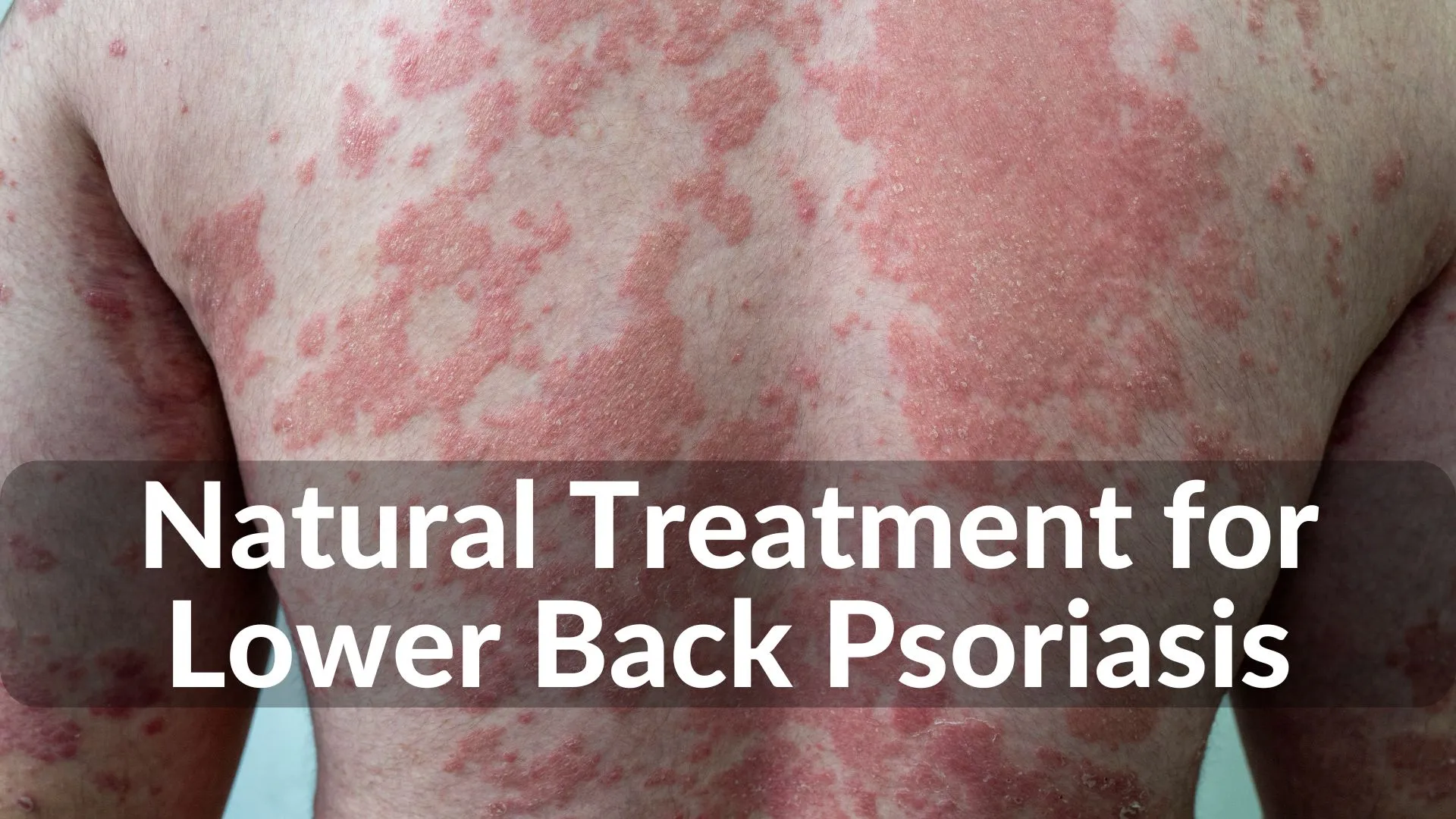 Best Natural Treatments for Lower Back Psoriasis Healing