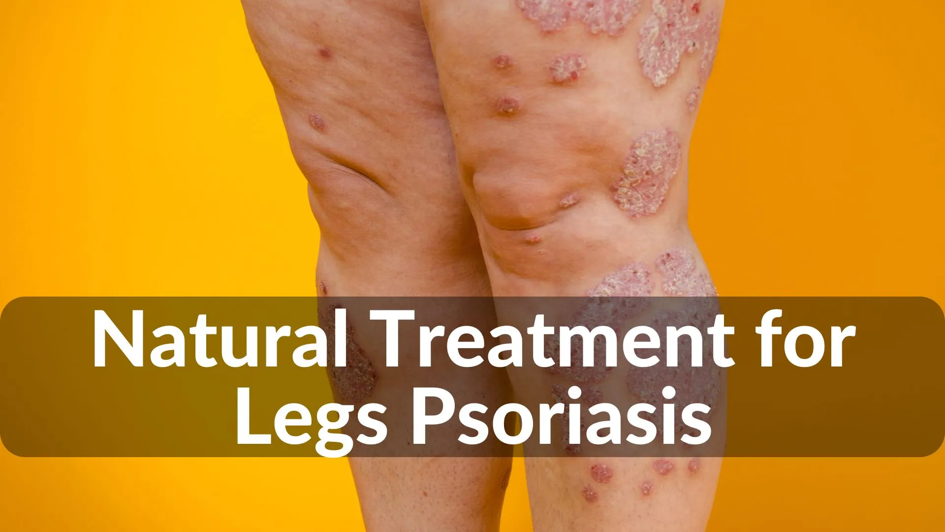 Best Natural Treatments for Leg Psoriasis Healing