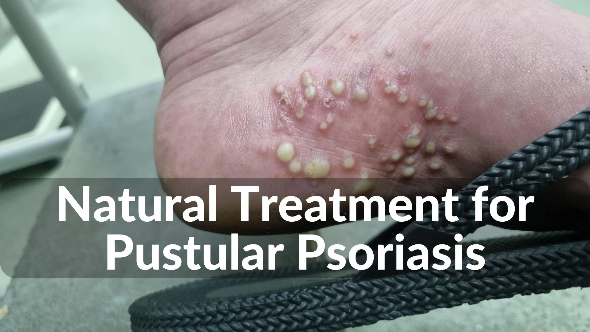 Best Natural Treatments for Pustular Psoriasis: Holistic Healing