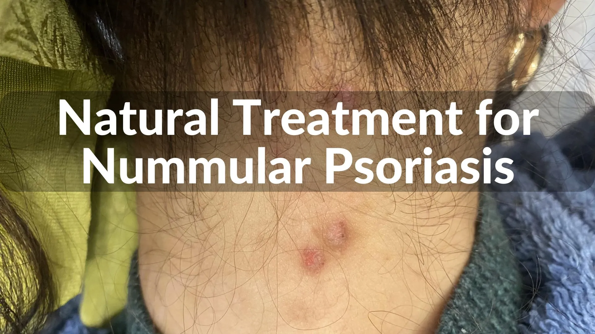 Best Natural Treatments for Nummular Psoriasis: Holistic Healing